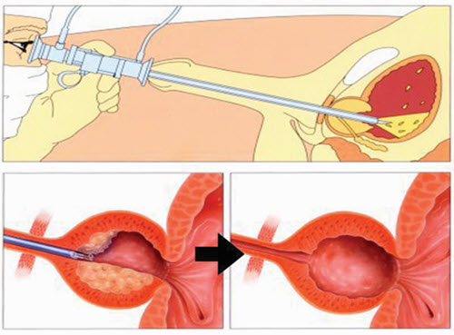 برداشتن پروستات از طريق مجراي ادراري